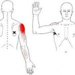 Trigger Points and Shoulder Pain